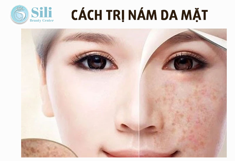 cách trị nám da mặt hiệu quả