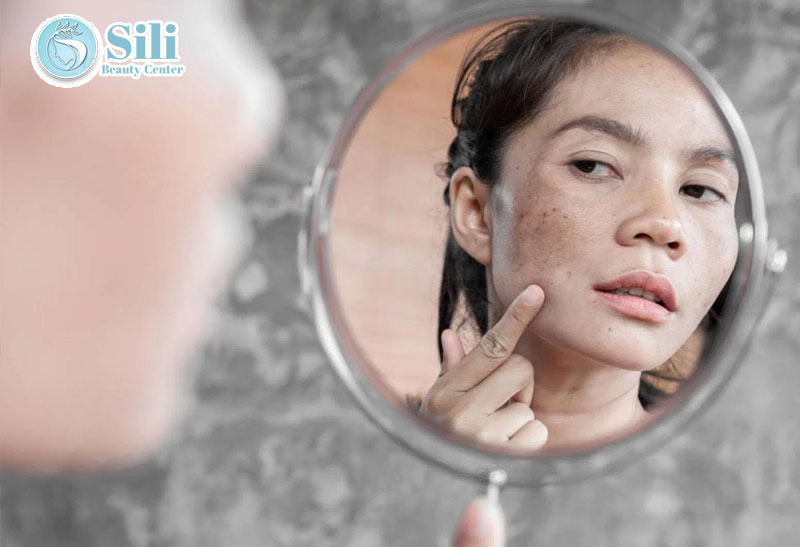 cách trị nám da mặt