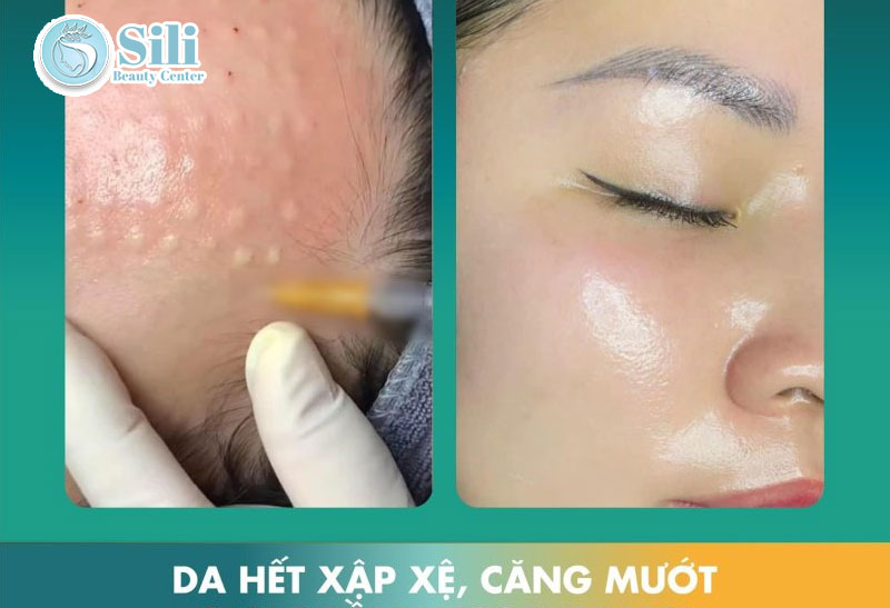 cấy meso