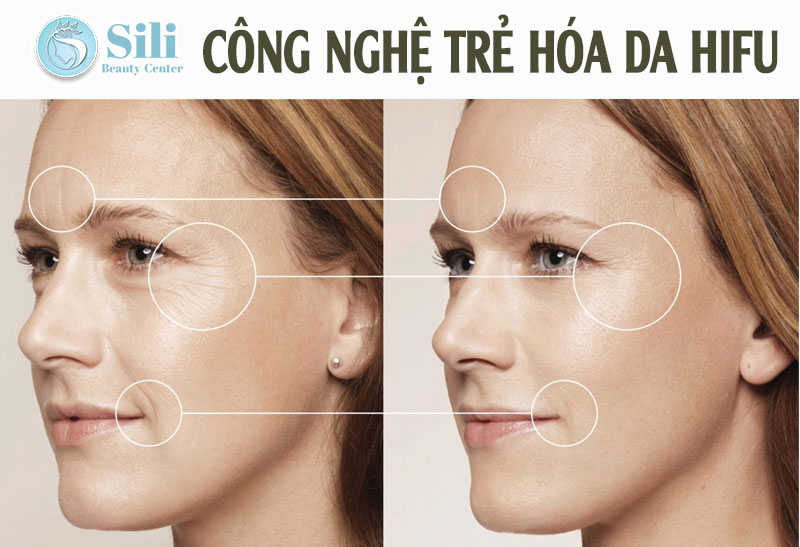 công nghệ hifu