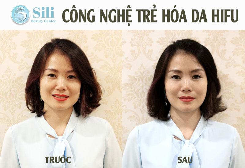 công nghệ hifu