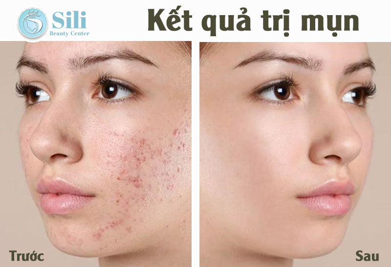 điều trị mụn