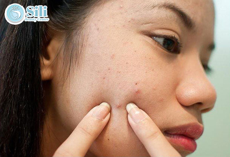 có nên nặn mụn hay không