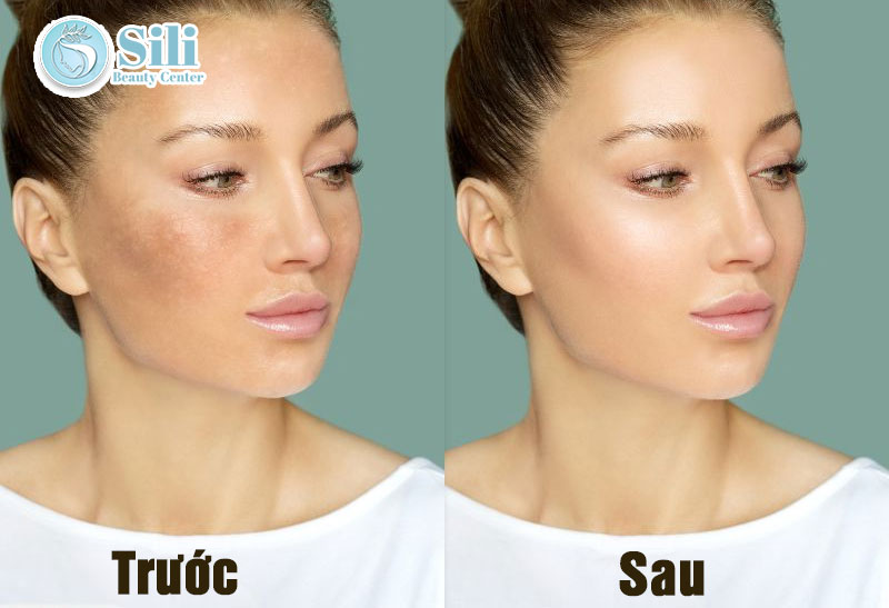 trước và sau khi phục hồi da hư tổn
