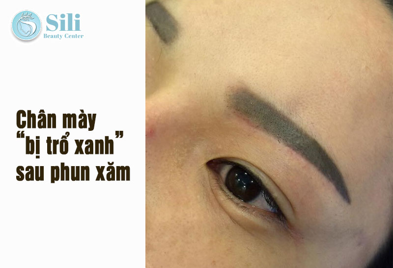 phun mày bị trổ xanh 