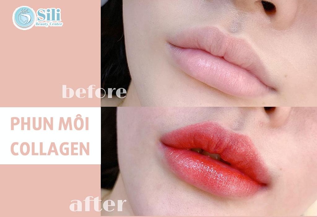 Phun môi Collagen