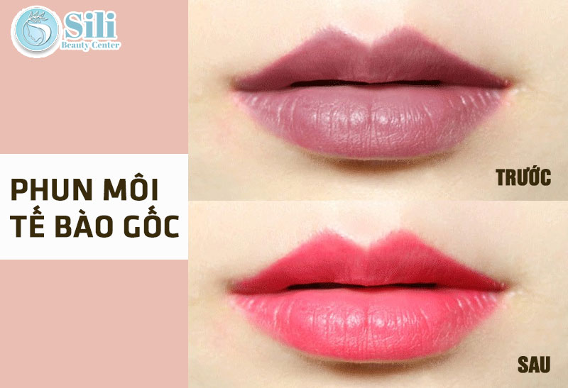 phun môi tế bào gốc