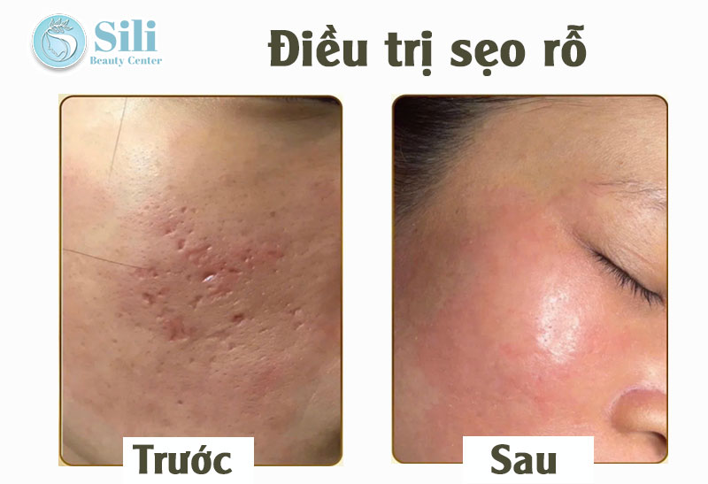 điều trị sẹo rỗ