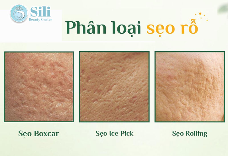 phân loại sẹo rỗ