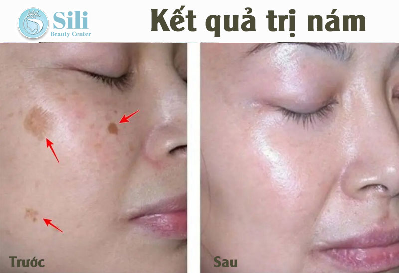 trị nám da