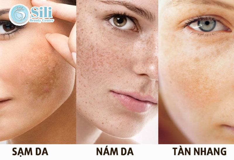 trị nám tàn nhang