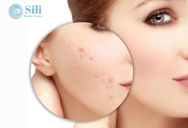 trị thâm hiệu quả