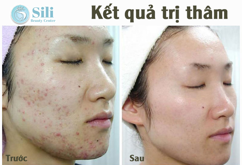 trị thâm hiệu quả