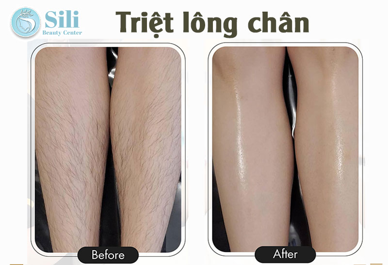 kết quả triệt lông chân