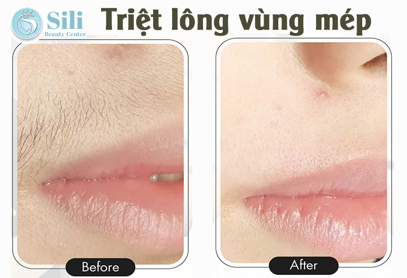kết quả triệt lông mép