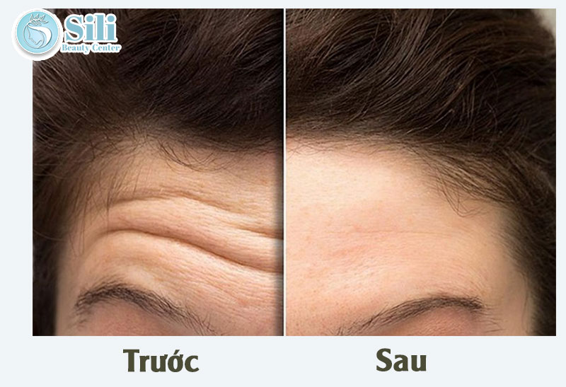 kết quả triệt lông trán