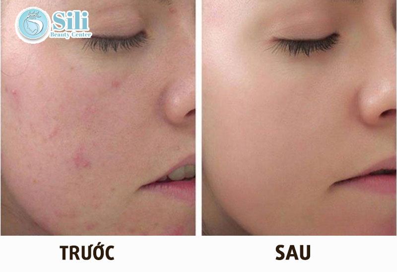 trước và sau khi peel da