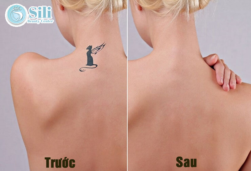 kết quả trước và sau khi xóa xăm