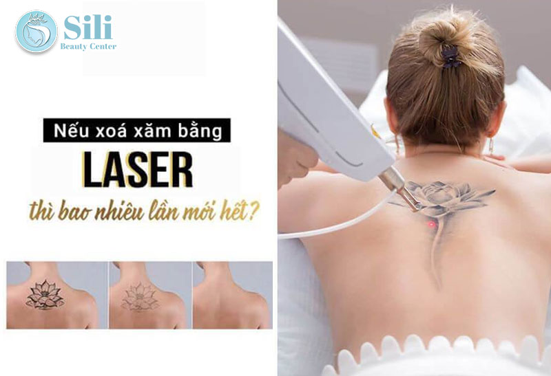 xóa xăm bằng laser