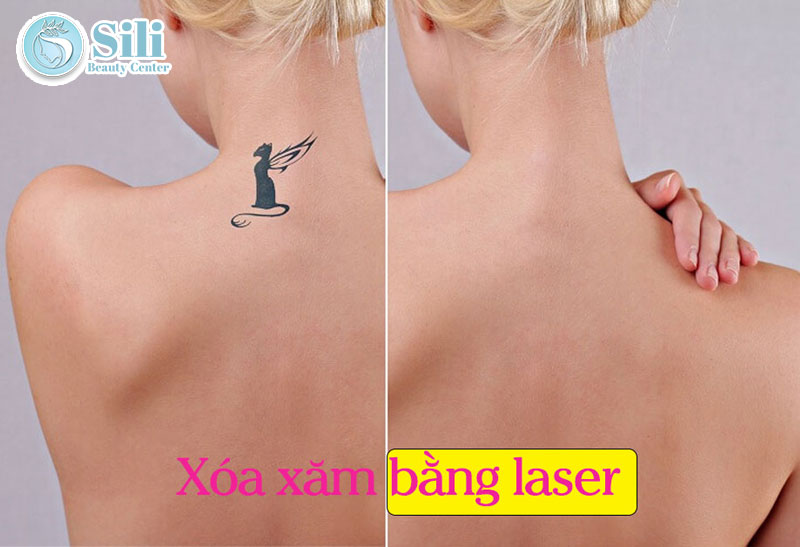 xóa xăm bằng laser