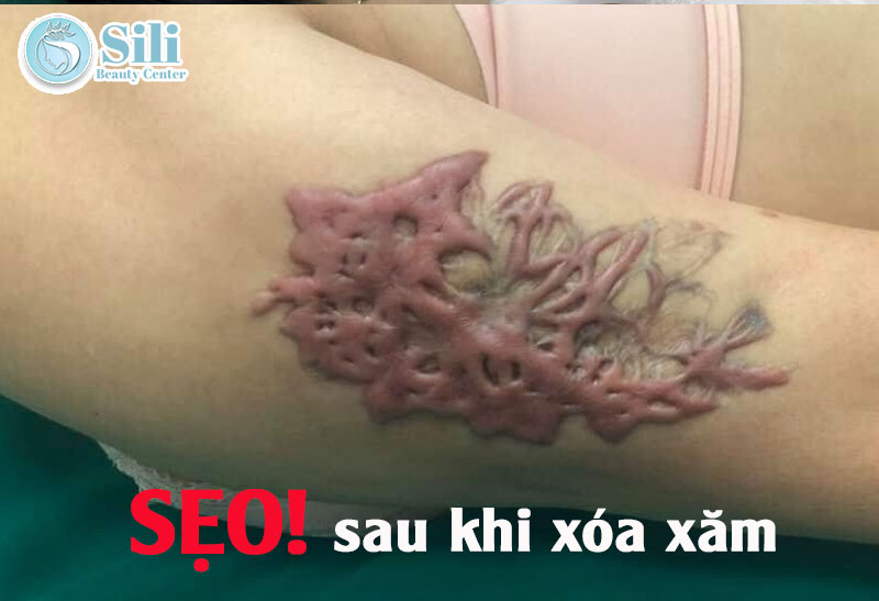 xóa xăm có để lại sẹo không