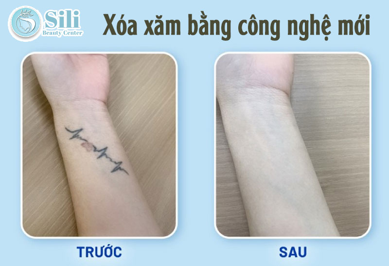 kết quả xóa hình xăm