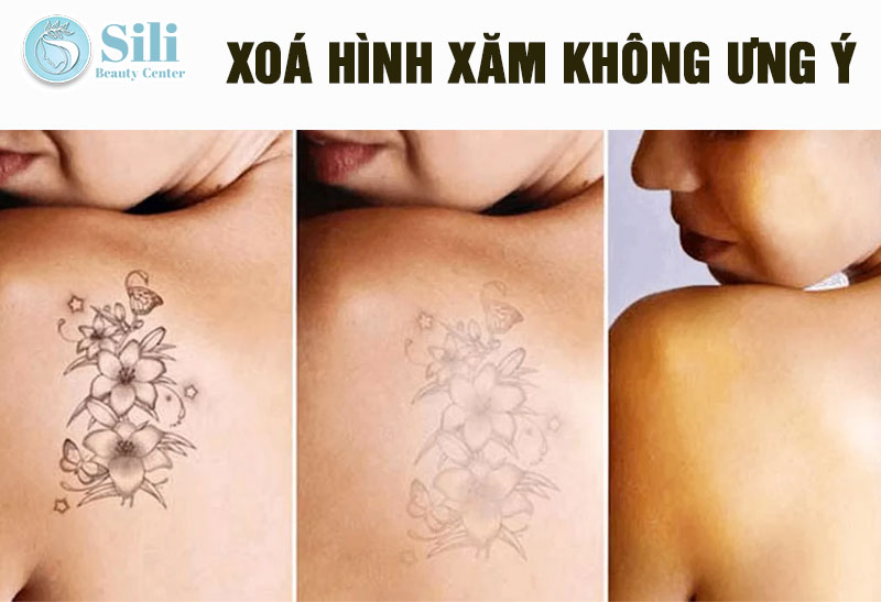 dịch vụ xoá xăm
