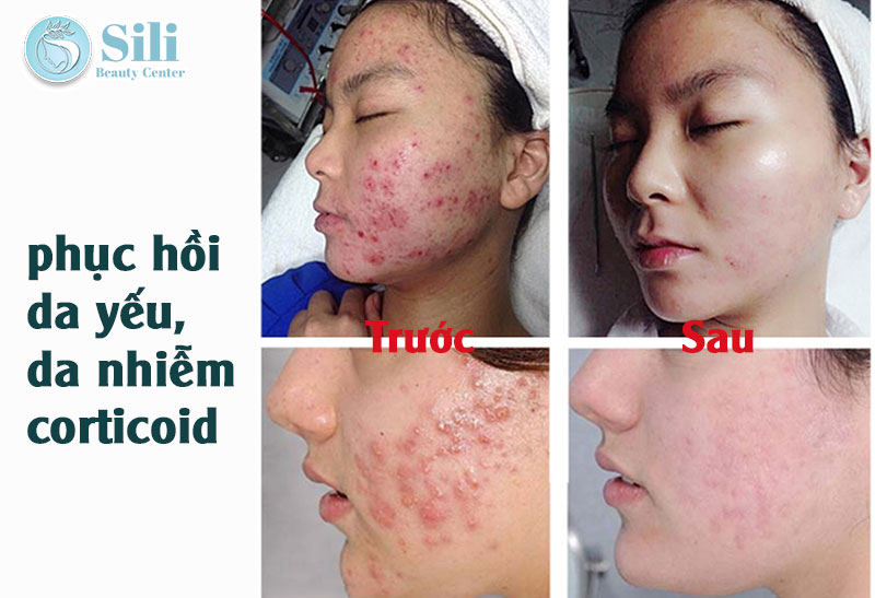 phục hồi da nhiễm corticoid