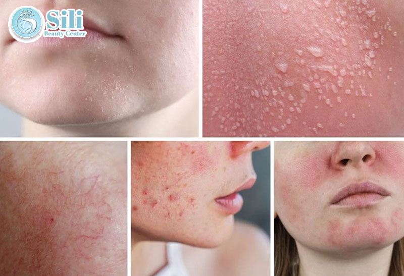 phục hồi da nhiễm corticoid