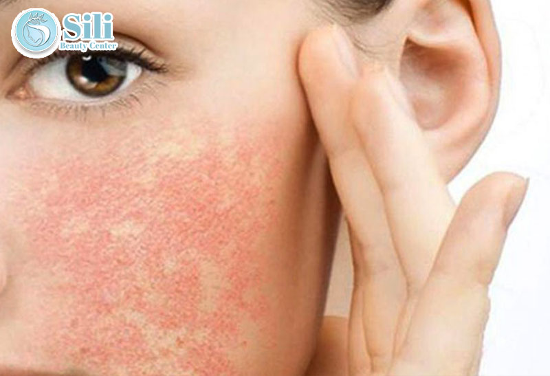 điều trị da tổn thương do mỹ phẩm