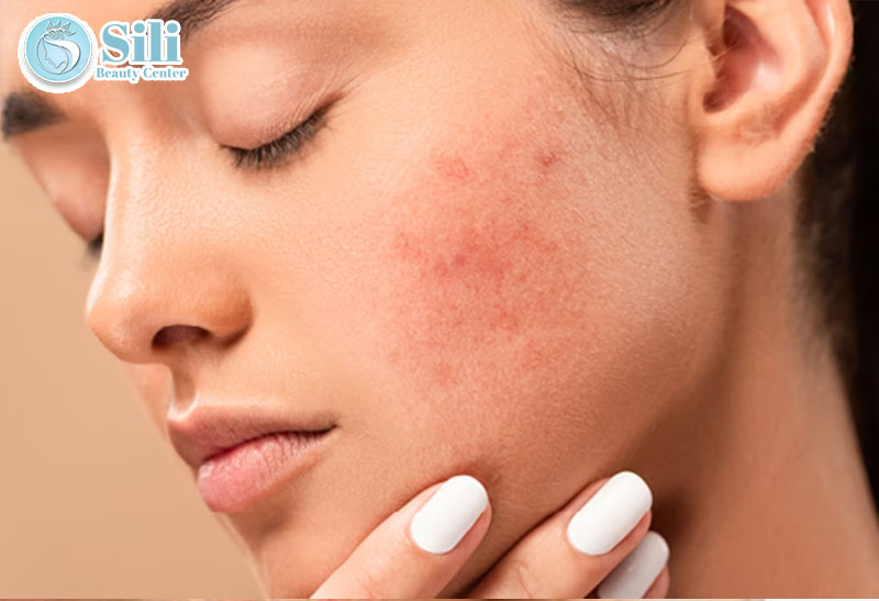 điều trị da tổn thương do mỹ phẩm