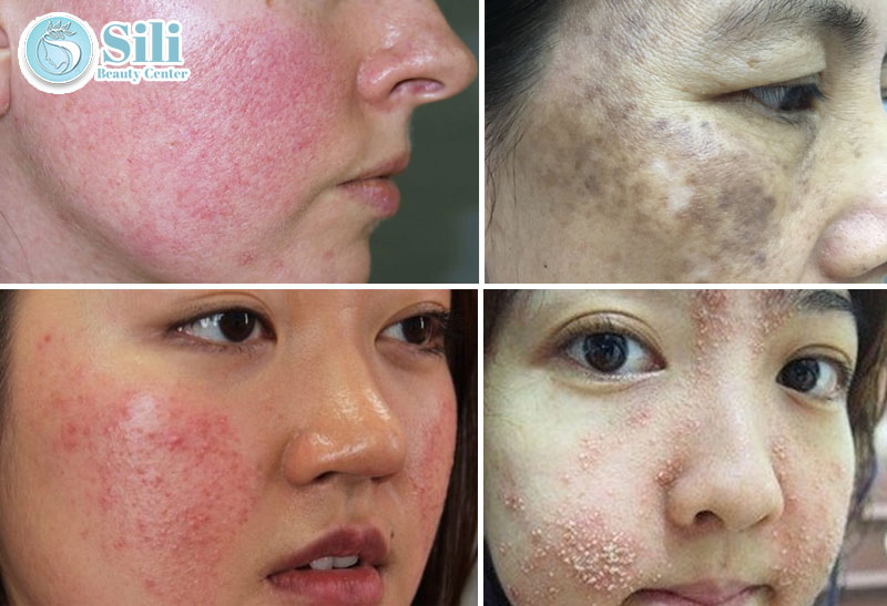 da yếu sau kem trộn