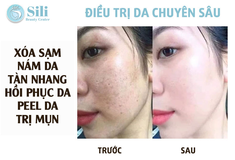 điều trị da chuyên sâu