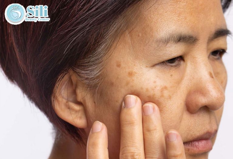 Đừng chủ quan khi bị nám da
