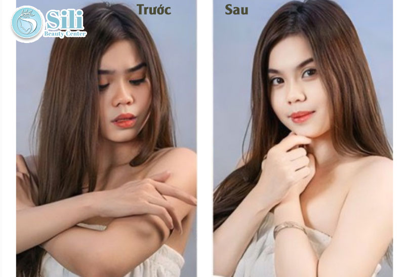 kết quả tắm trắng