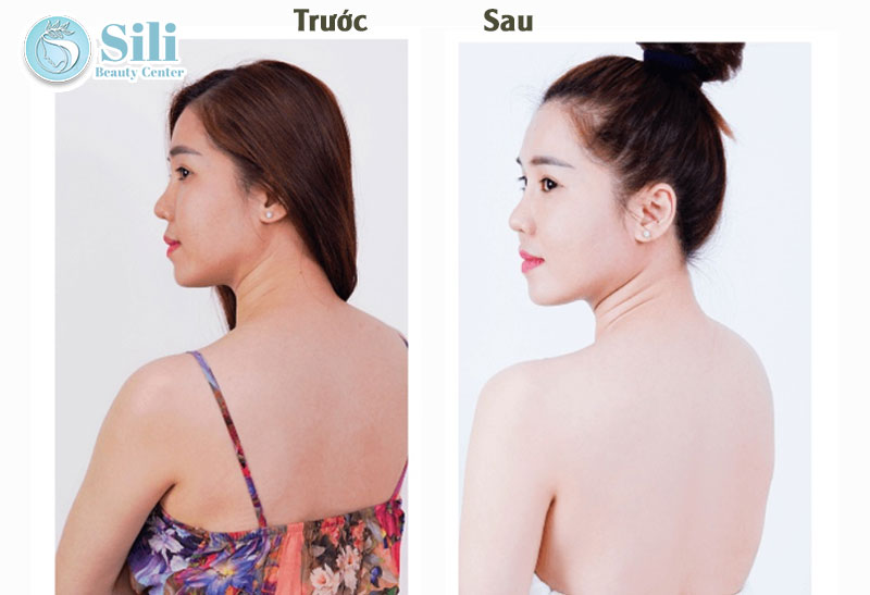 kết quả tắm trắng