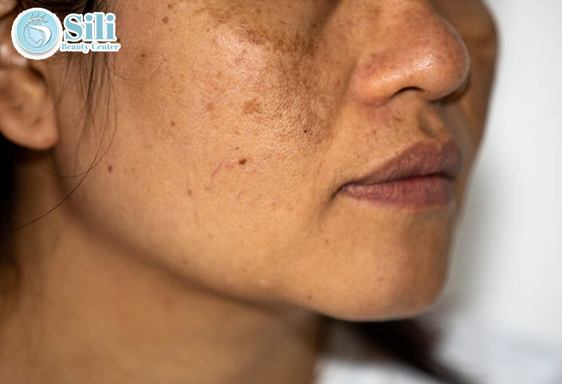 nám hỗn hợp