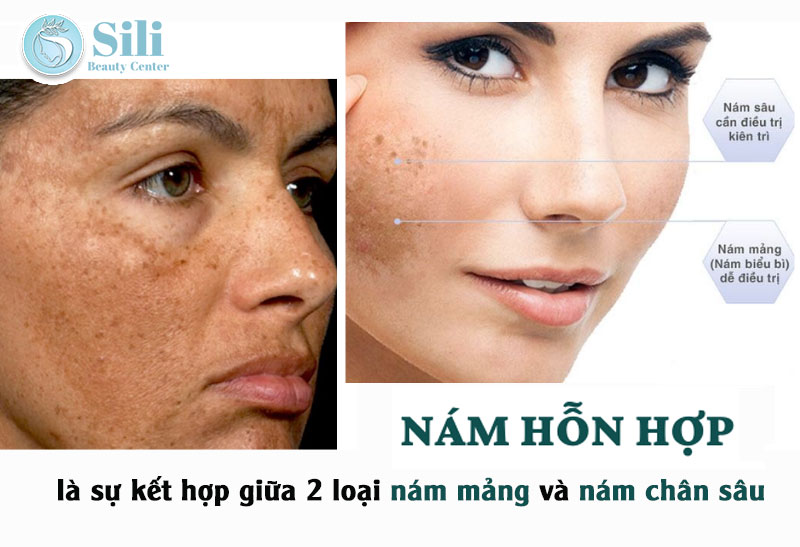 nám hỗn hợp