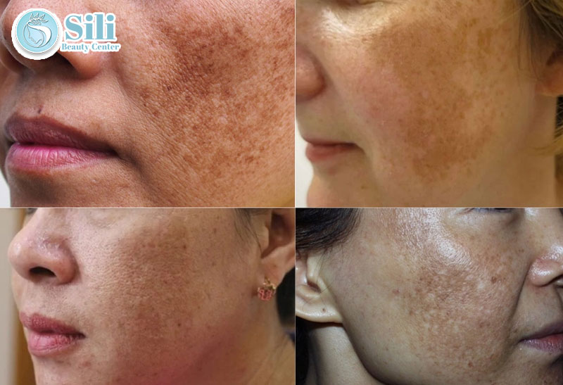 biểu hiện nám mảng