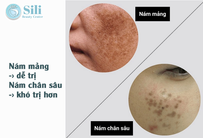 phân biệt nám mảng và nám chân sâu