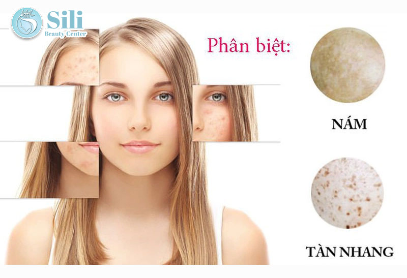phân biệt nám và tàn nhang