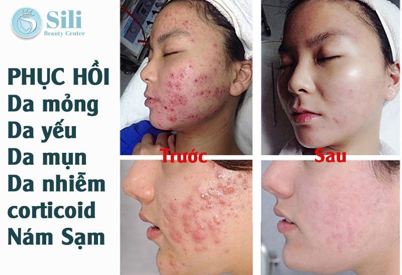 phục hồi da hư tổn tại Sili Beauty Center