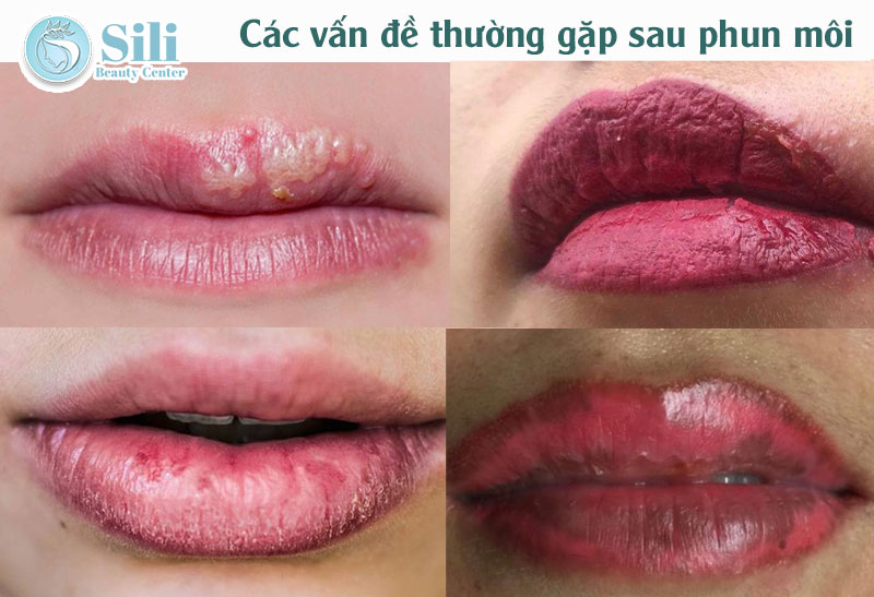 Vấn đề thường gặp sau khi phun môi