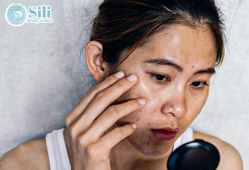 sạm da là gì