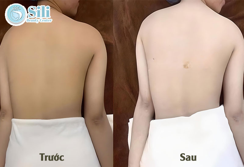 kết quả tắm trắng