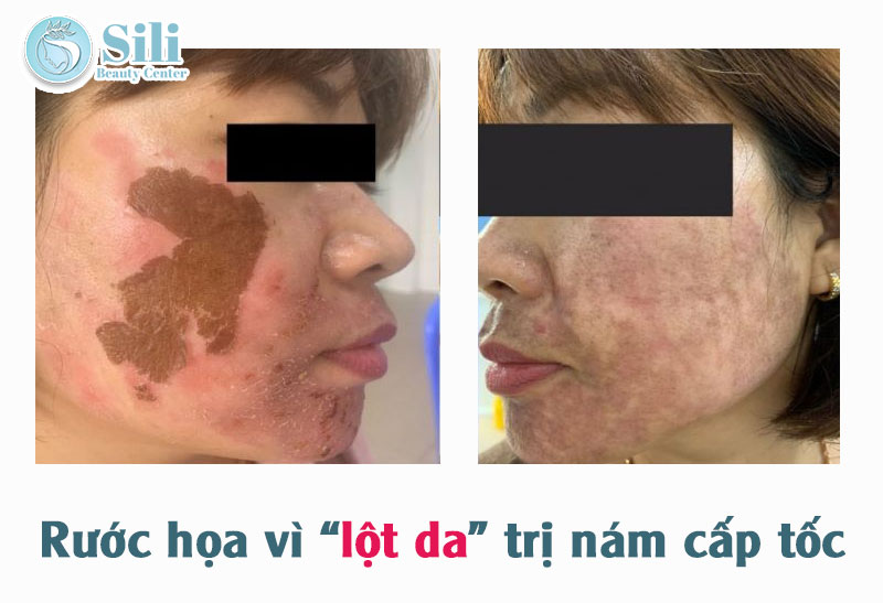 trị nám cấp tốc