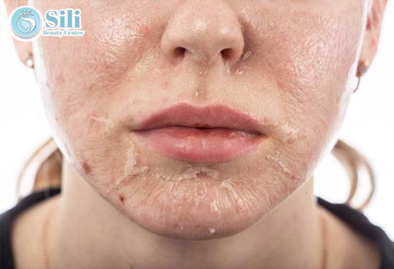 trị nám cấp tốc