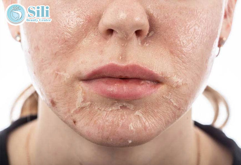 trị nám cấp tốc