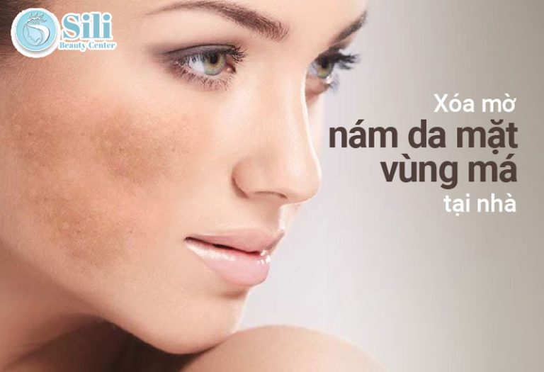 trị nám tại nhà