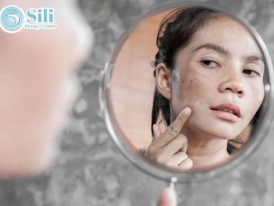 cách trị nám da mặt